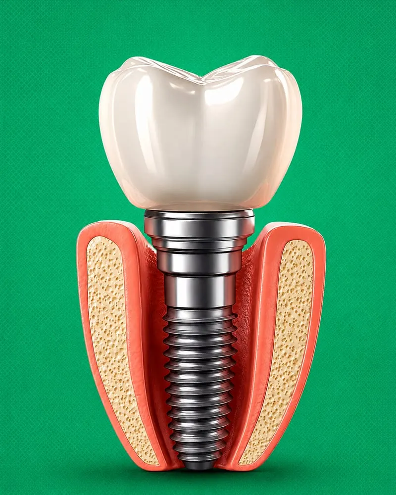 Implantes na CDC Odonto